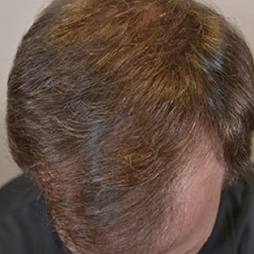 Depois do tratamento