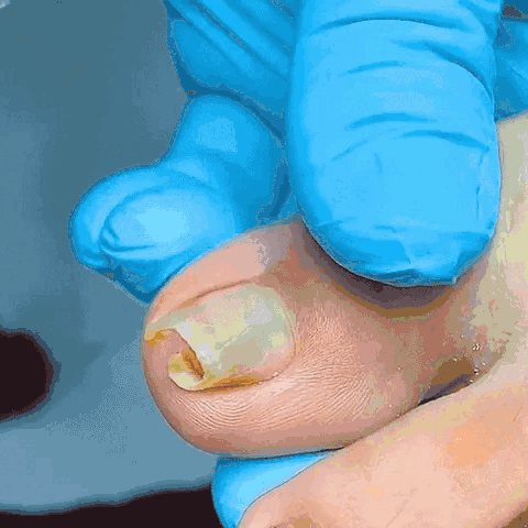 Resultados Mico Cream