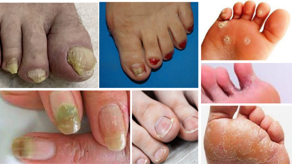 Problema fungos unhas