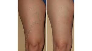 Resultado María Carmen