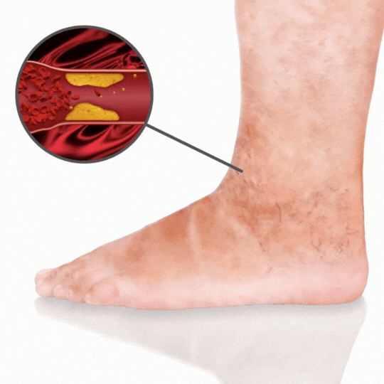 Tratamiento Veniselle