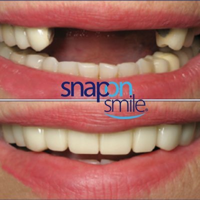 Snap On Smile - Facetas Dentárias