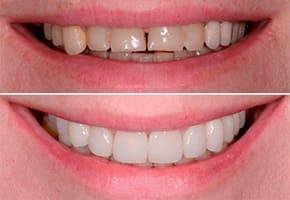 Antes e depois cliente 1