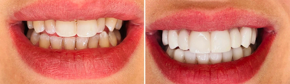 Antes e depois cliente 5